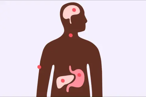 Illustration av en mänsklig silhuett med markerade organ som hjärna, hals, mage och lever. Röda prickar indikerar potentiella problemområden, vilket väcker frågan: kan man få feber av stress?